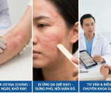 Các bệnh viêm da cơ địa, dị ứng