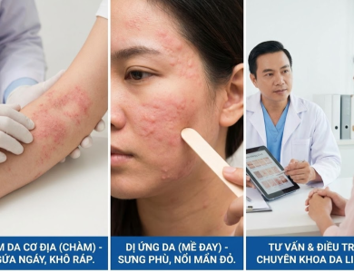 Các bệnh viêm da cơ địa, dị ứng