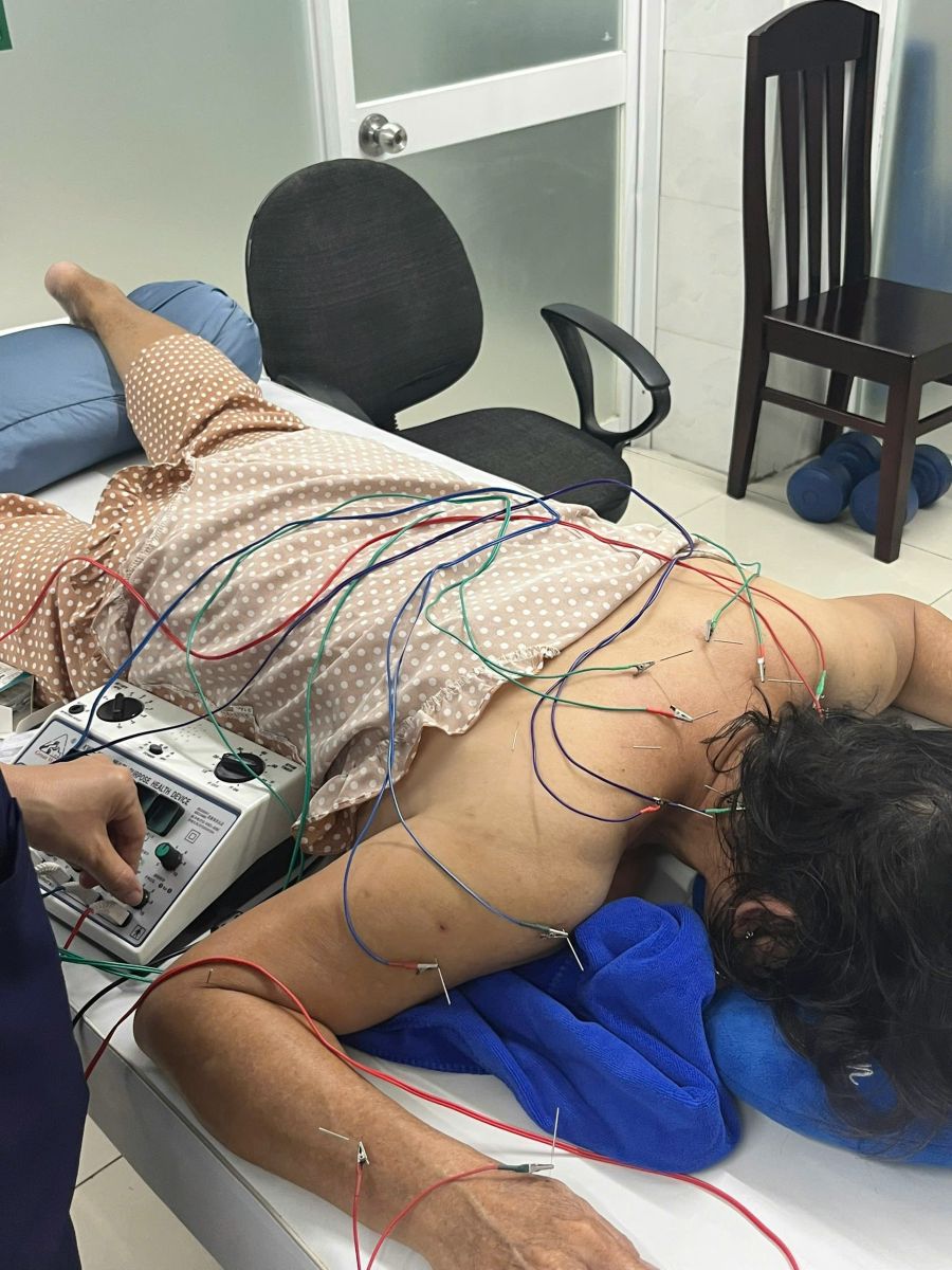 Điện châm giúp kích thích khí huyết trong các kinh mạch