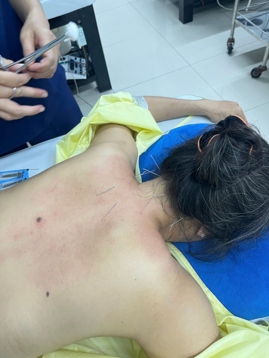 Cấy chỉ vào các huyệt đạo mang lại hiệu quả điều trị bền vững