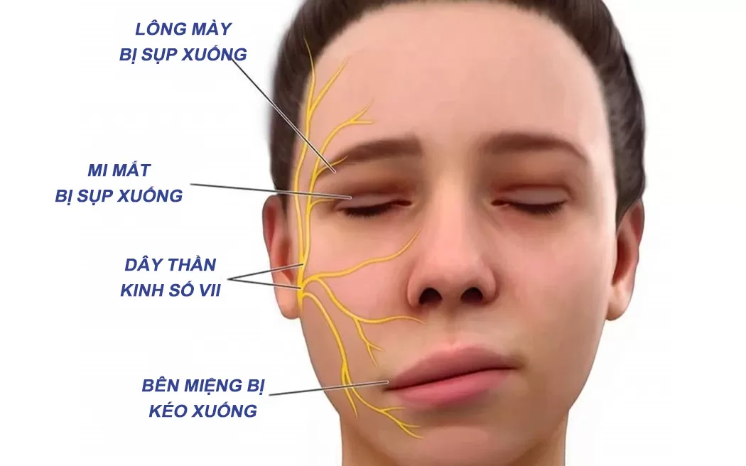 Di chứng liệt dây thần kinh mặt có thể bao gồm nhiều tình trạng khác nhau