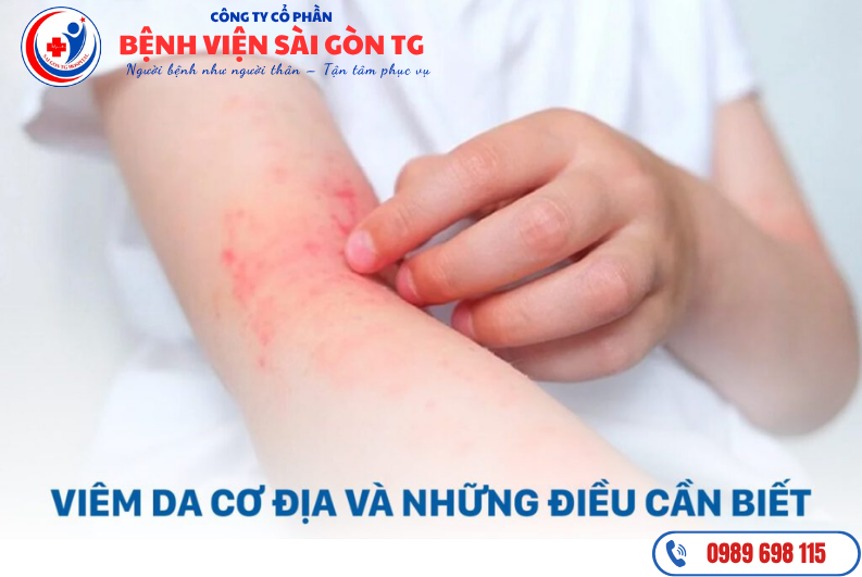 Viêm da cơ địa thường gây ngứa ngáy, đỏ và viêm da