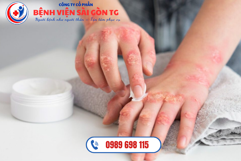 Ở người lớn, viêm da cơ địa thường xuất hiện ở khuỷu tay, đầu gối và cổ tay, thường có tính chất đối xứng.