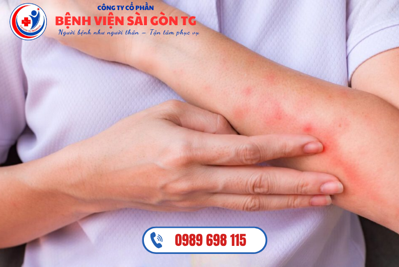 Ngứa là triệu chứng đặc trưng nhất của viêm da cơ địa, cảm giác này rất khó chịu, thường xuất hiện về tối, gây khó ngủ.