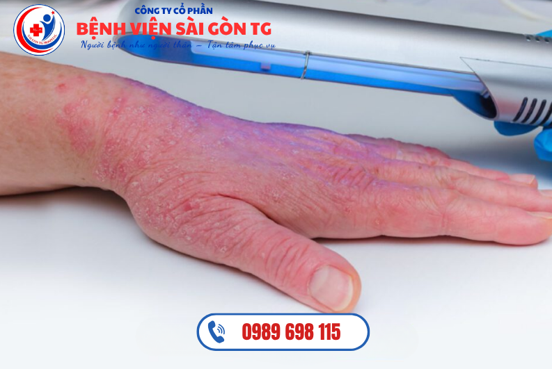 Phương pháp quang trị liệu sử dụng tia cực tím dải hẹp (UV) để giảm viêm và ngăn ngừa bùng phát viêm da cơ địa.