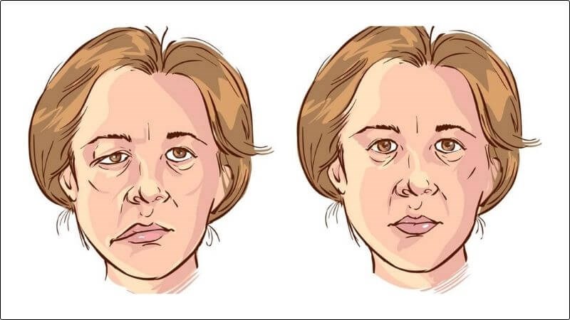 Liệt mặt gồm hai dạng chính phổ biến